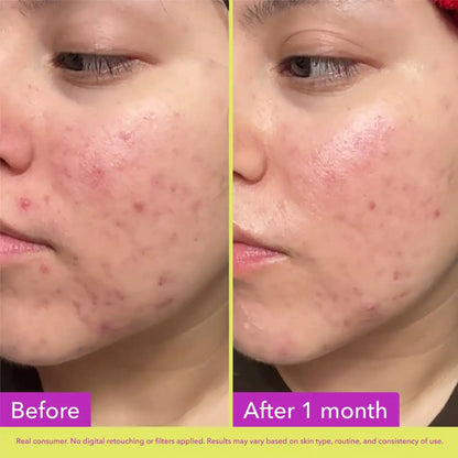 Good Molecules 10% Azelaic Acid Treatment 30ml