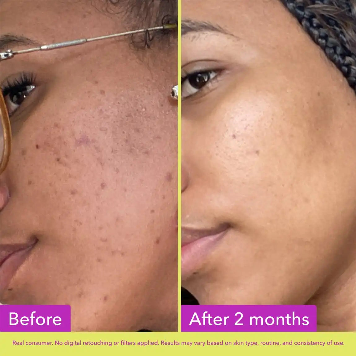 Good Molecules 10% Azelaic Acid Treatment 30ml